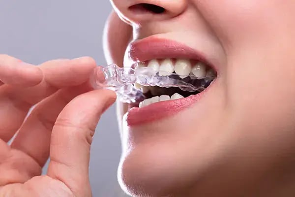 Mouth guard
